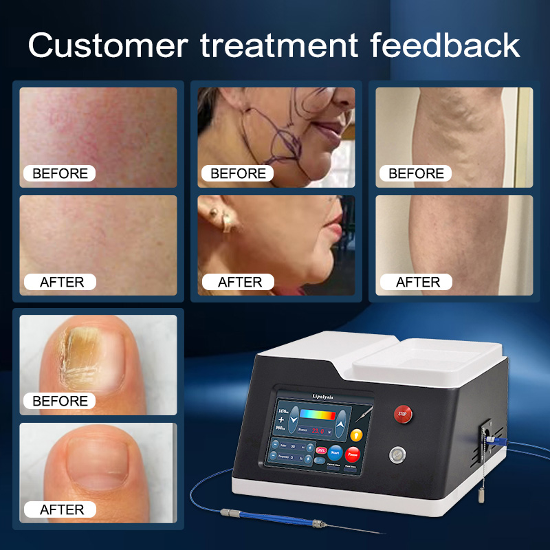 https://www.hongqilaser.com/ru/product/fractional-co2-laser-machine/feed/