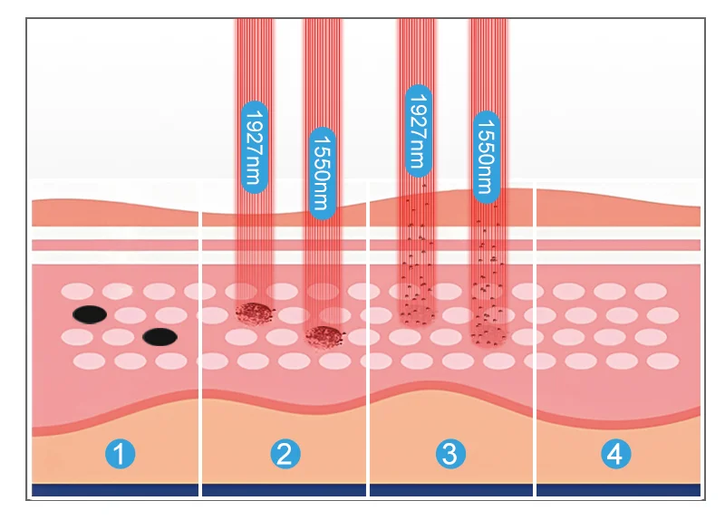 Diagram showing 1550nm and 1927nm laser penetration levels