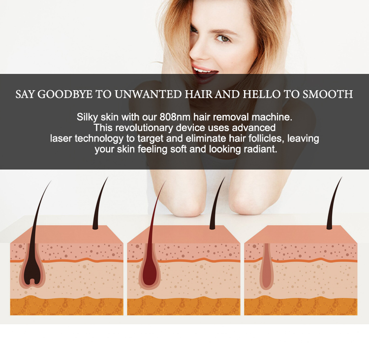 808nm diode laser hair removal principle with laser energy targeting hair follicles
