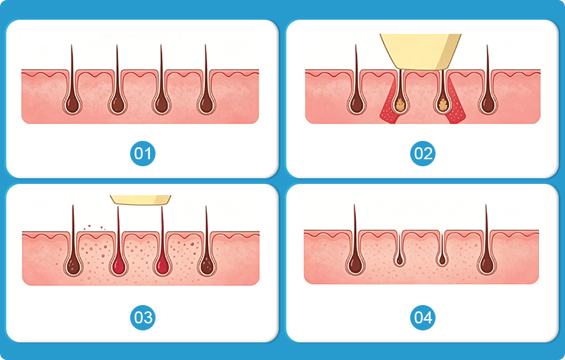 Four-step DPL hair treatment process diagram