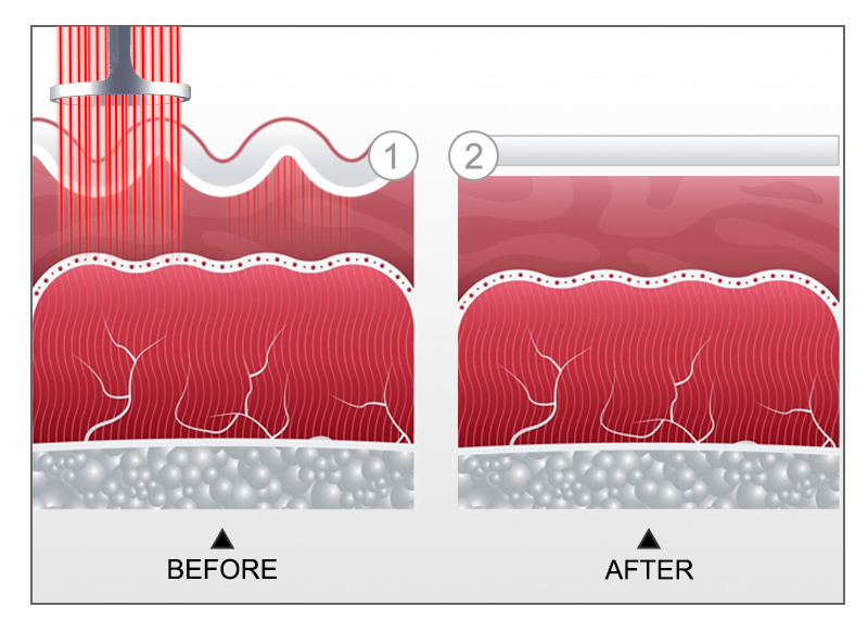 Diagram of fractional CO2 laser beams penetrating dermis before and after treatment