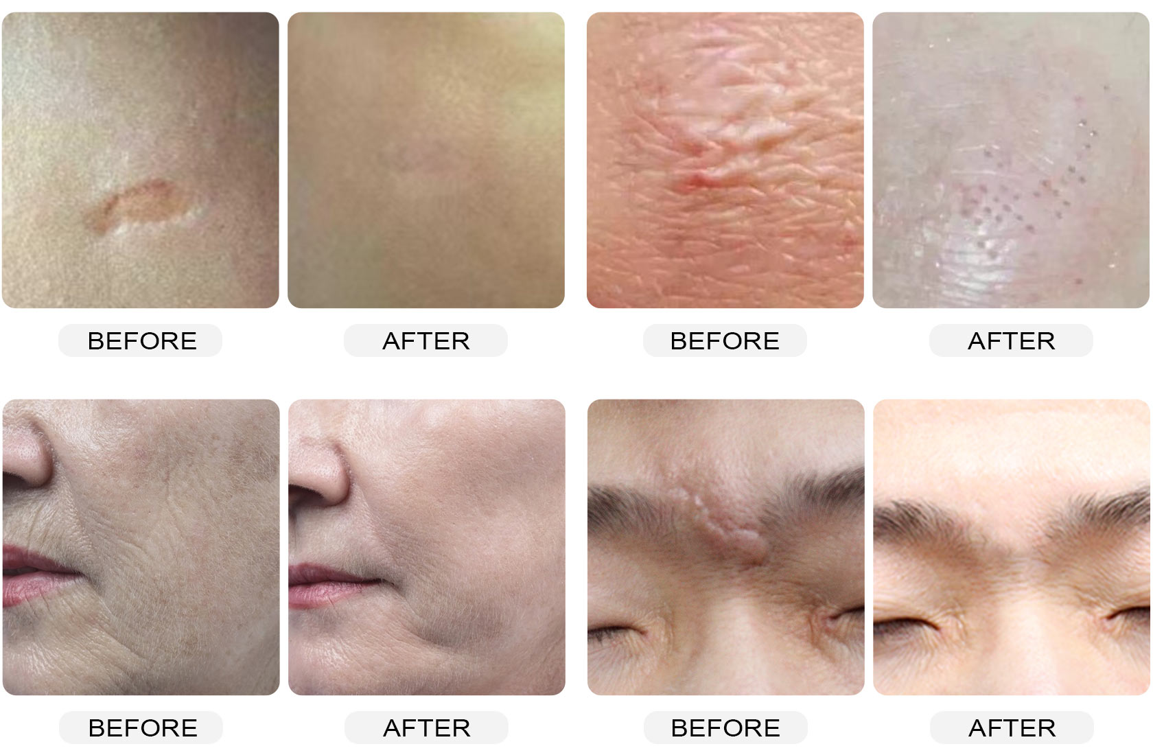 Before and after clinical treatment results for scars, wrinkles, and texture improvement