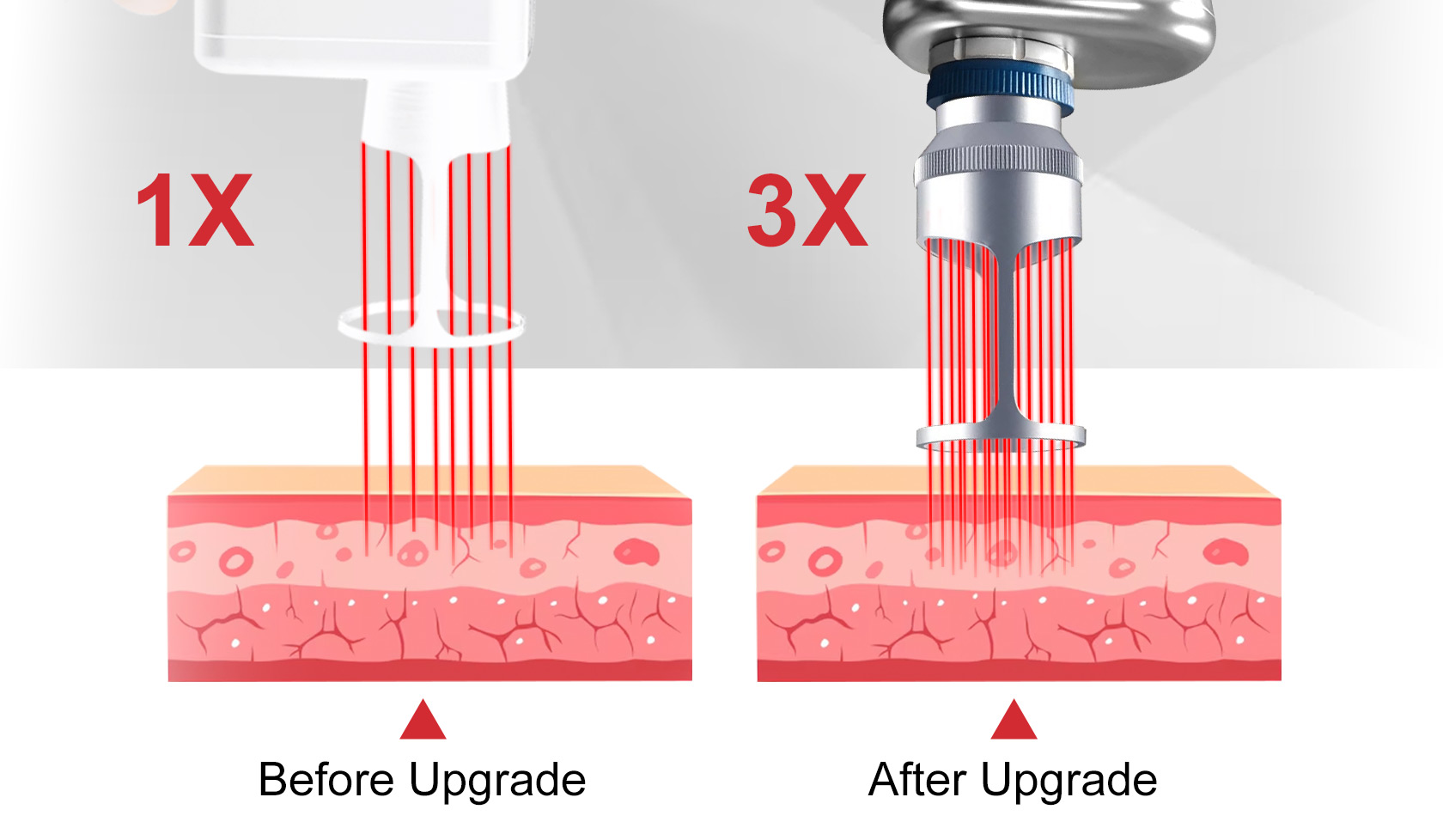 Comparison of 1X standard versus 3X upgraded fractional laser beam density