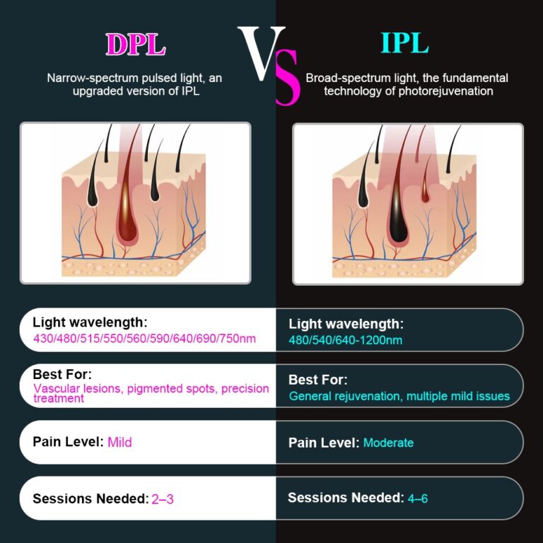 DPL vs IPL Technology