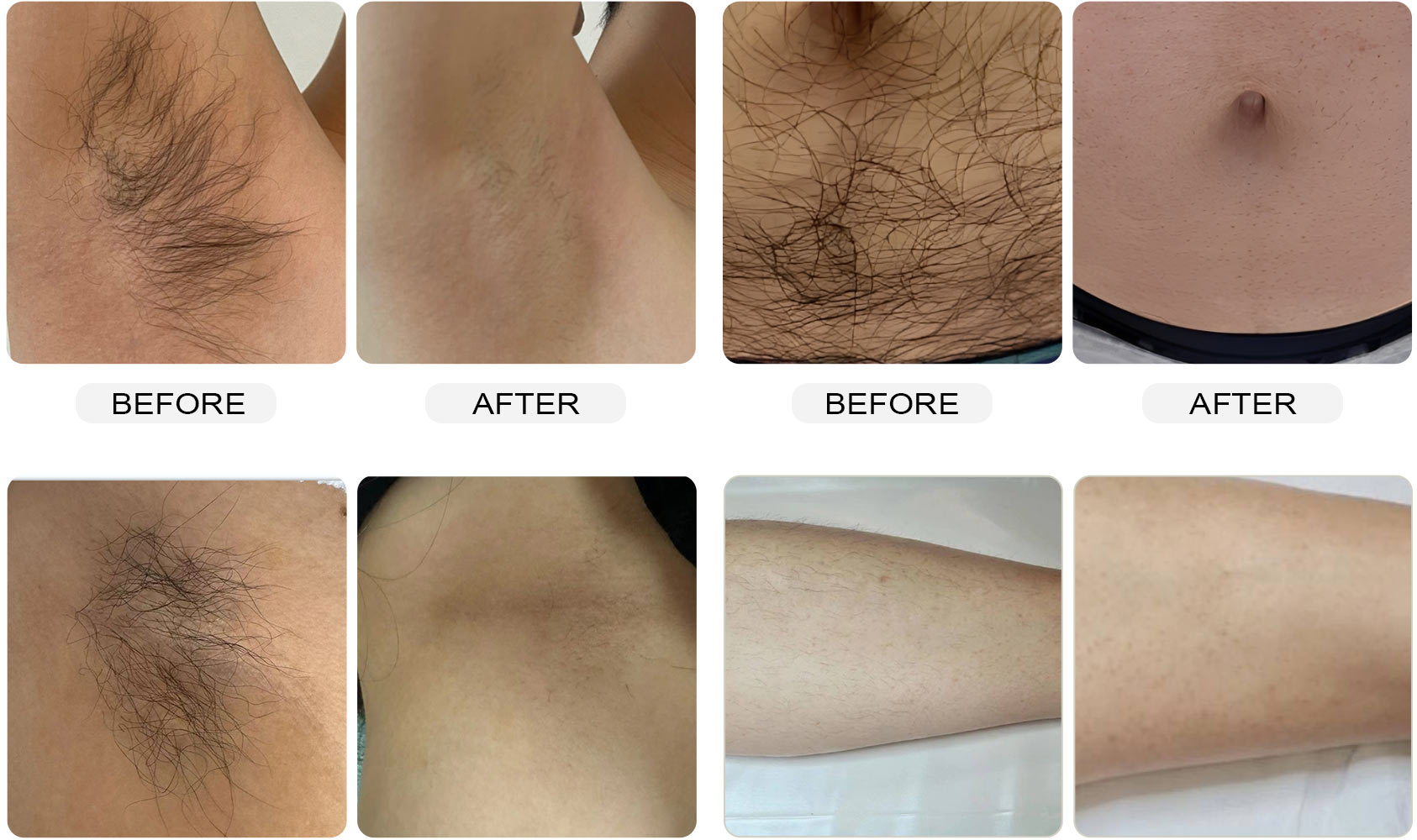Before and after body hair appearance comparison for diode laser hair removal