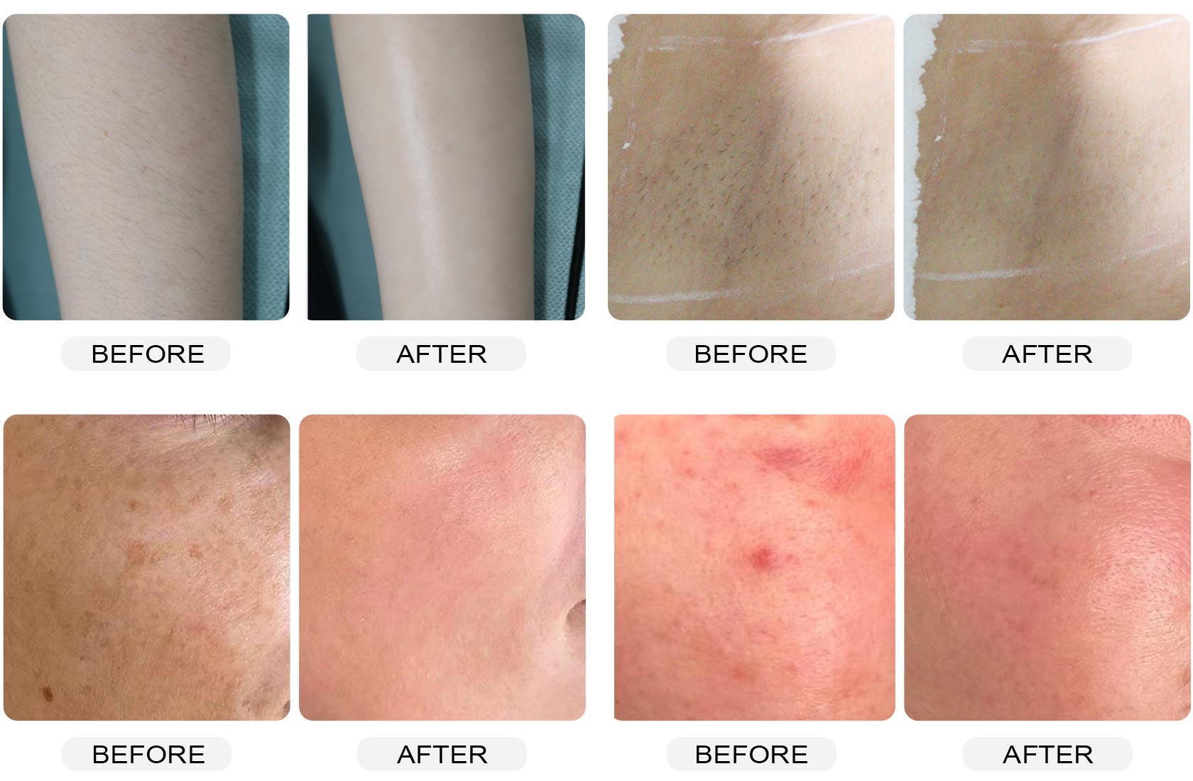 Before-and-after images of DPL hair and skin treatments